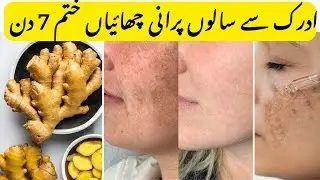 Amazing way to remove freckles with ginger|reduce melasma,pigmentation,discolouration black spot |