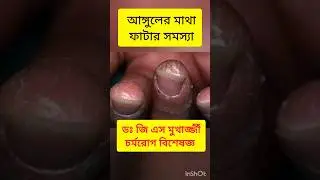 Finger tip eczema|| Best dermatologist Dr G S Mukherjee|| #doctor #bangla #skinspecialist #birbhum