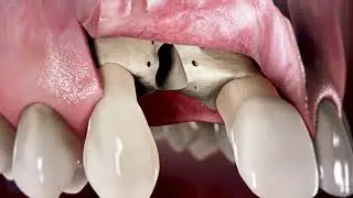 Patient education: 3D animations &ndash; Quintessence Publishing | interActive Systems, Berlin