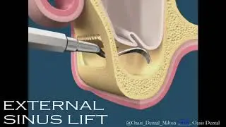 What is a Lateral Window Sinus Lift | Dental Implant Specialist Team Milton, Oakville, Mississauga