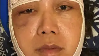 FACIAL FEMINIZATION TRANSFORMATION #shorts #fyp #mtf #beauty #transwoman #ffs