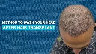 Hair Wash After 7-10 Days of Hair Transplant | JJ Aesthetics