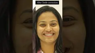 Deepa sathish smile correction at Opal dentistry #deepasathishdiaries #opaldentistry #invisalign