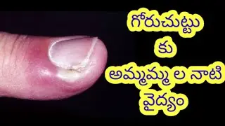 గోరుచుట్టు కు అమ్మమ్మల నాటి వైద్యం / Home remedies to treat paronychia ( goru chuttu ) in telugu
