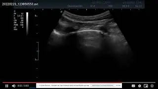 Point of Care Pulmonar- Lung Sliding- Deslizamento Pleural
