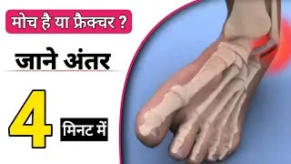 मोच या फ्रैक्चर ? Растяжение связок или перелом? Как узнать, растяжение связок или перелом? | Док...