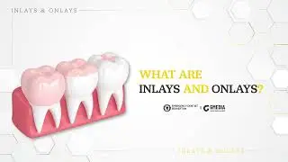 [Emergency Dentist Beaverton] Storytelling: What are Inlays and Onlays?