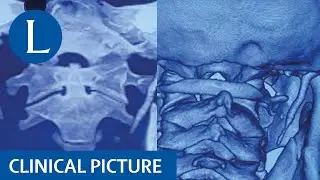 La sindrome di Eagle causa mal di gola nella regione sottomandibolare