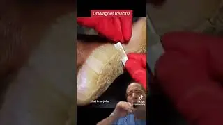 TAKE A LOOK AT THE SIZE OF THIS CALLUS💥#shorts
