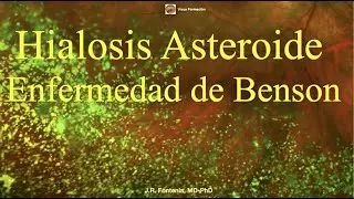 Hialosis Asteroide, Enfermedad de Benson, Scintillatio Nívea o Scintillatio Albescens.