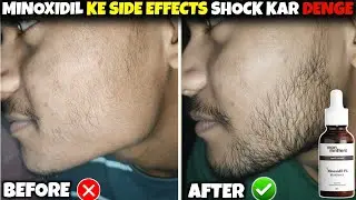 Minoxidil Beard Growth | Benefits & Dangerous Side Effects | Beard Growth Tips 2025 |