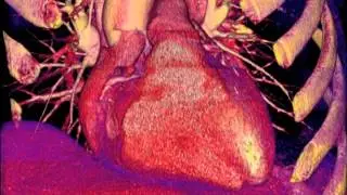 UCSF Radiology: How Well Do CT Scans See Into the Heart?
