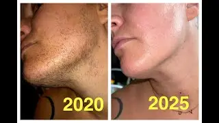 4 Year Update: recap of my ENTIRE 170 hour electrolysis facial hair removal journey, PCOS Hirsutism
