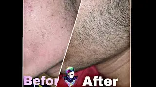 Minoxidil beard journey | Two months results🔥