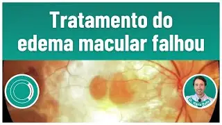Tratamento do edema macular falhou - o que fazer?