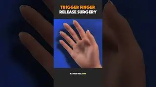 How Trigger Finger Surgery REALLY Works 😬! #facts #knowledge  #interestingfacts #interesting #shorts