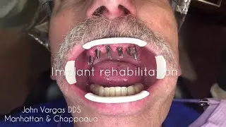 Dr. John Vargas : Full upper dental implant reconstruction. Cement retained zirconia layered