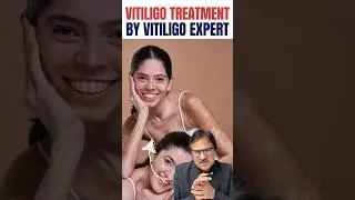 Is the treatment of white spots expensive? Truth About Cost, & Repigmentation. #shorts #trending ...