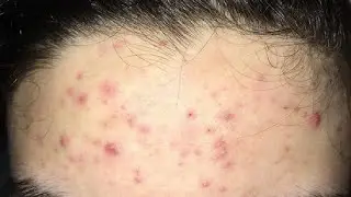 КАК ИЗБАВИТЬСЯ ОТ ПРЫЩЕЙ НА ЛБУ БЫСТРЫЙ РЕЗУЛЬТАТ