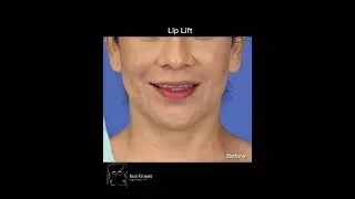 Lip Lift Results| Before and After| Plastic Surgery
