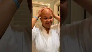 (1/2)Maintenance day as an alopecia girly in Miami for the first time!! #diy #alopecia #maintenance