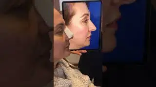 Watch This Revision Rhinoplasty by Dr. Michel Siegel At The Facial Center for Plastic Surgery!