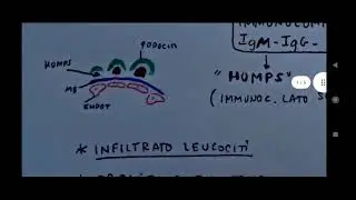 Glomerulonefrite post streptococcica e oncocitoma renale - anatomia patologica