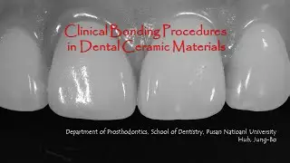 치과의사와 치과기공사를 위한 Dental Ceramic Bonding 원리