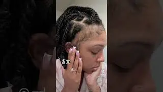 1 Month vs. 2 Months Using Minoxidil on My Edges &ndash; The Results Are In! 🌱 #alopecia #minoxidil #hair