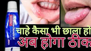 How to use hexigel in hindi