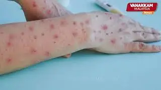 Kelantan residents returning from high-risk Mpox countries urged to report  state Health Department
