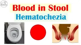 5 Causes of Blood in the Stool (Hematochezia) That You Should Know