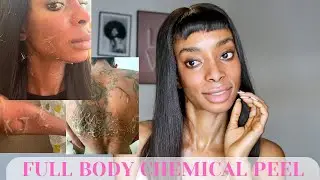 MY FULL BODY CHEMICAL PEEL EXPERIENCE | ON SENSITIVE SKIN OF COLOR