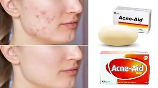 Acne aid Soap bar review and Price|| chahry k dagh dhaby aur chahry py dano ka ilaj Urdu Hindi