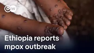 Why mpox is re-emerging on the African continent | DW News