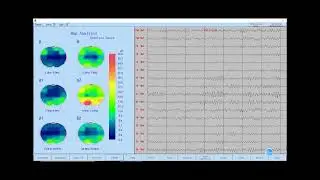 Software operation of NCC EEG machine