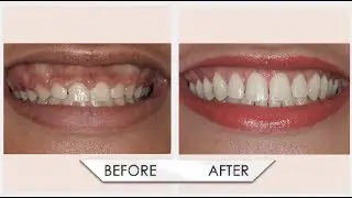Gummy Smile Treatment Can Change Your Life! 😁