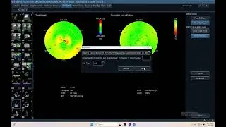 IQ 693 LV GWE MYOCARDIAL WORK EFFICINCY LVEF LV PSD LVTTP LV GLS ECHOCARDIOGRAPHY