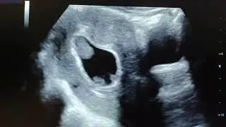 chorionic bump. part 1