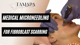 Medical Microneedling for Plasma Fibroblast Scarring