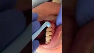 Sub gingival root brushing