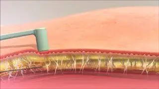 FaceTite RF Assisted Lipolysis Fat Removal by Board Certified Dallas Plastic Surgeon Dr. Farah Khan