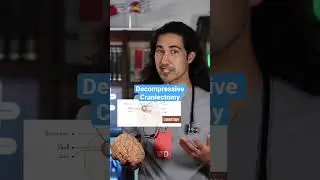 Краниэктомия! Реакция врача на операцию на мозге #краниотомия #реакцияврача #вдохновение