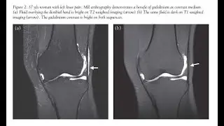 Contrast arthrography; imaging technique used to evaluate internal structures of a joint