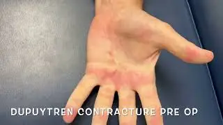 Dupuytren Contracture Release Before and After Surgery