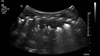 dynamic air bronchogram