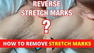 STRETCH MARKS HOW TO REMOVE || REVERSE STRETCH MARKS? ||  Fitsecrets Tv |