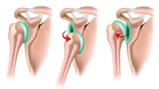 how to fix shoulder dislocation#excercise#nutrition#gymworkout#shoulderdislocation#bonesetting