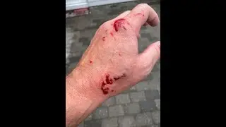 Uheld ved fodring af de store slanger/ Accident feeding the large snakes (Burmese Python)🇩🇰