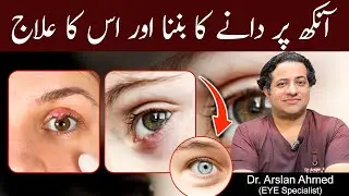 Ankh Par Dana ka ilaj | Stye On Eyelid | Treatment Of Eye Pimple by Dr. Arslan Ahmed